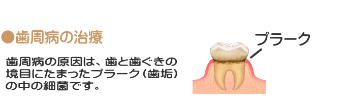 歯周病の原因は、歯と歯ぐきの境目にたまったプラーク(歯垢)の中の細菌です。