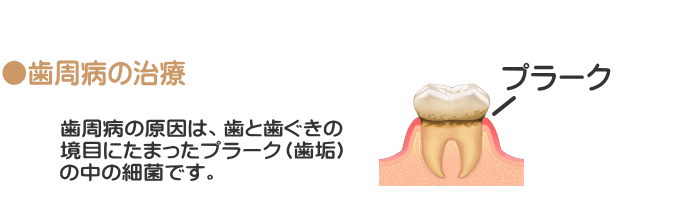 歯周病の原因は、歯と歯ぐきの境目にたまったプラーク(歯垢)の中の細菌です。