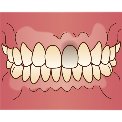 千葉市・四街道市の歯医者さん、神経の死んだ歯を白く、ウォーキングブリーチ