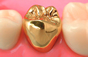 歯医者、ゴールドクラウン、金歯